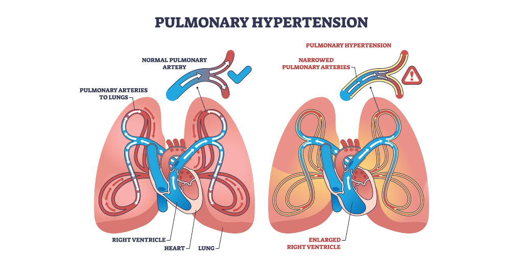 Could Your Client’s Pulmonary Hypertension Diagnosis Actually Fall Outside Their CI Cover?
